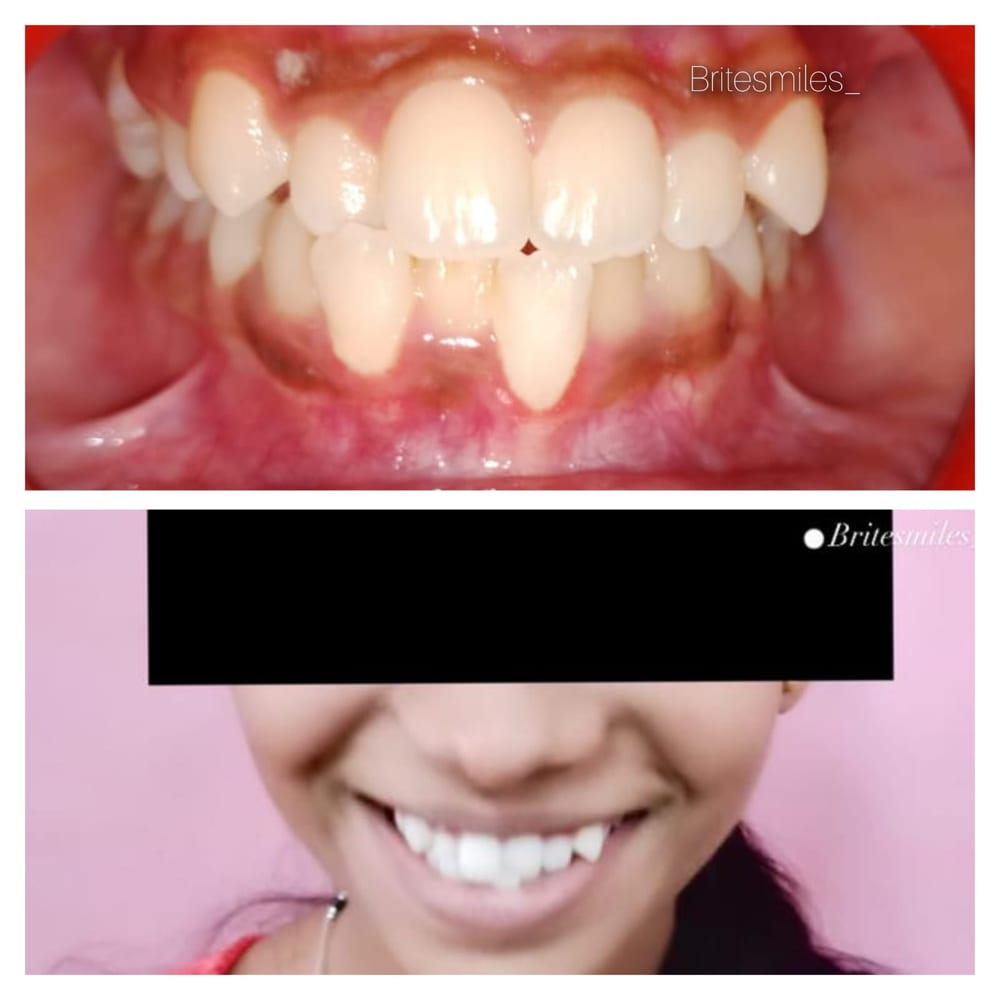 Orthodontics Case - Before