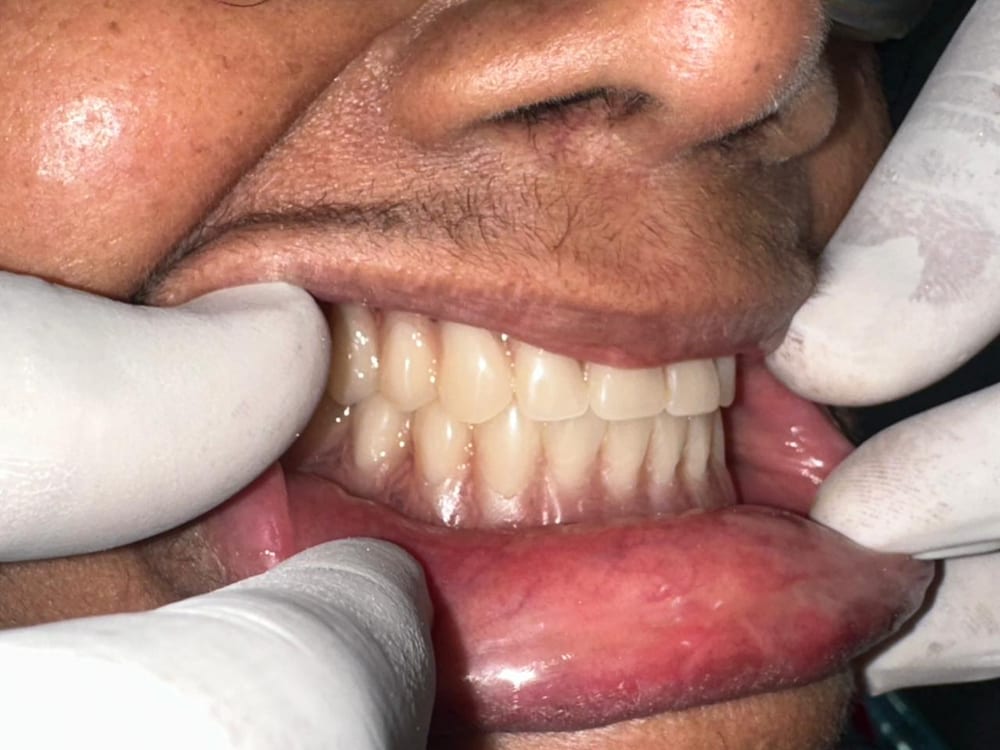 Implant Case - After