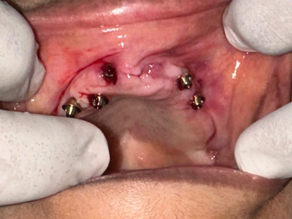 Implant Case - Before