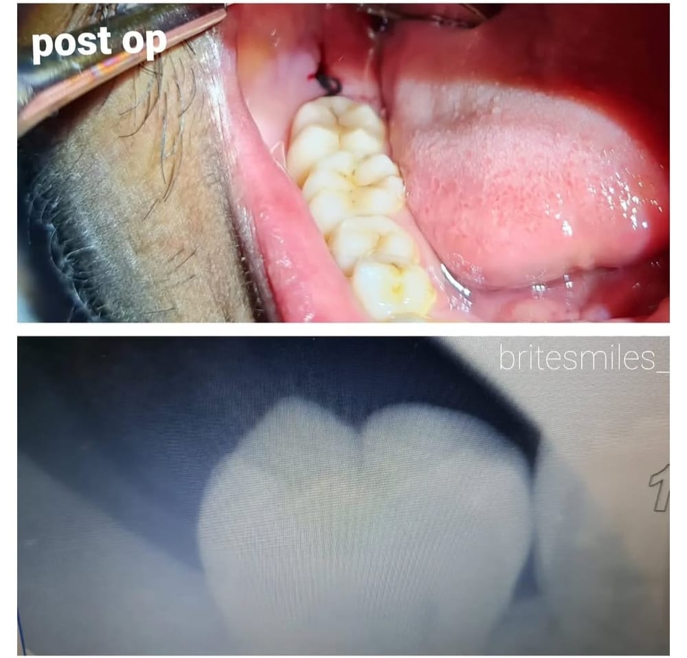 Wisdom Tooth Extraction - After