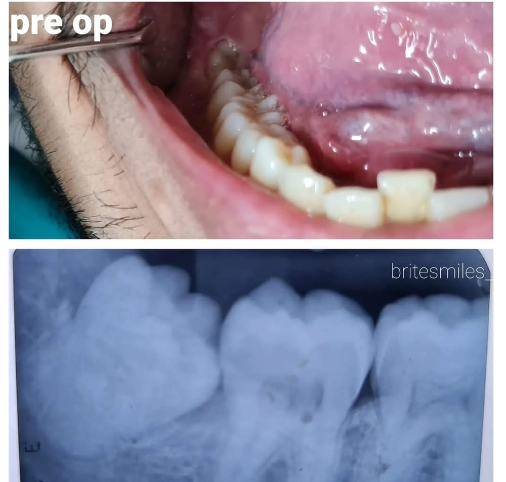 Wisdom Tooth Extraction - Before