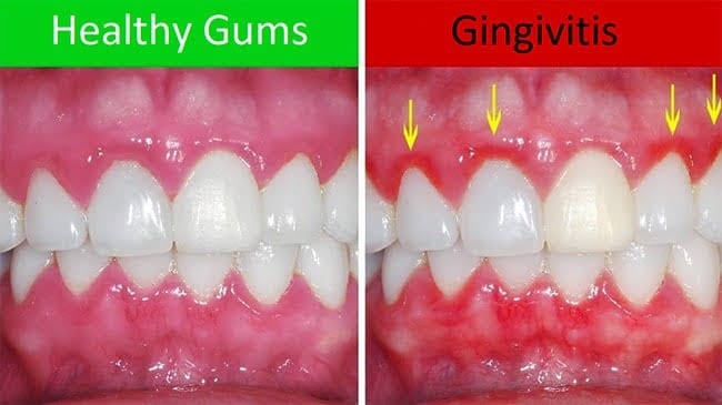Periodontal Gum Therapy Case