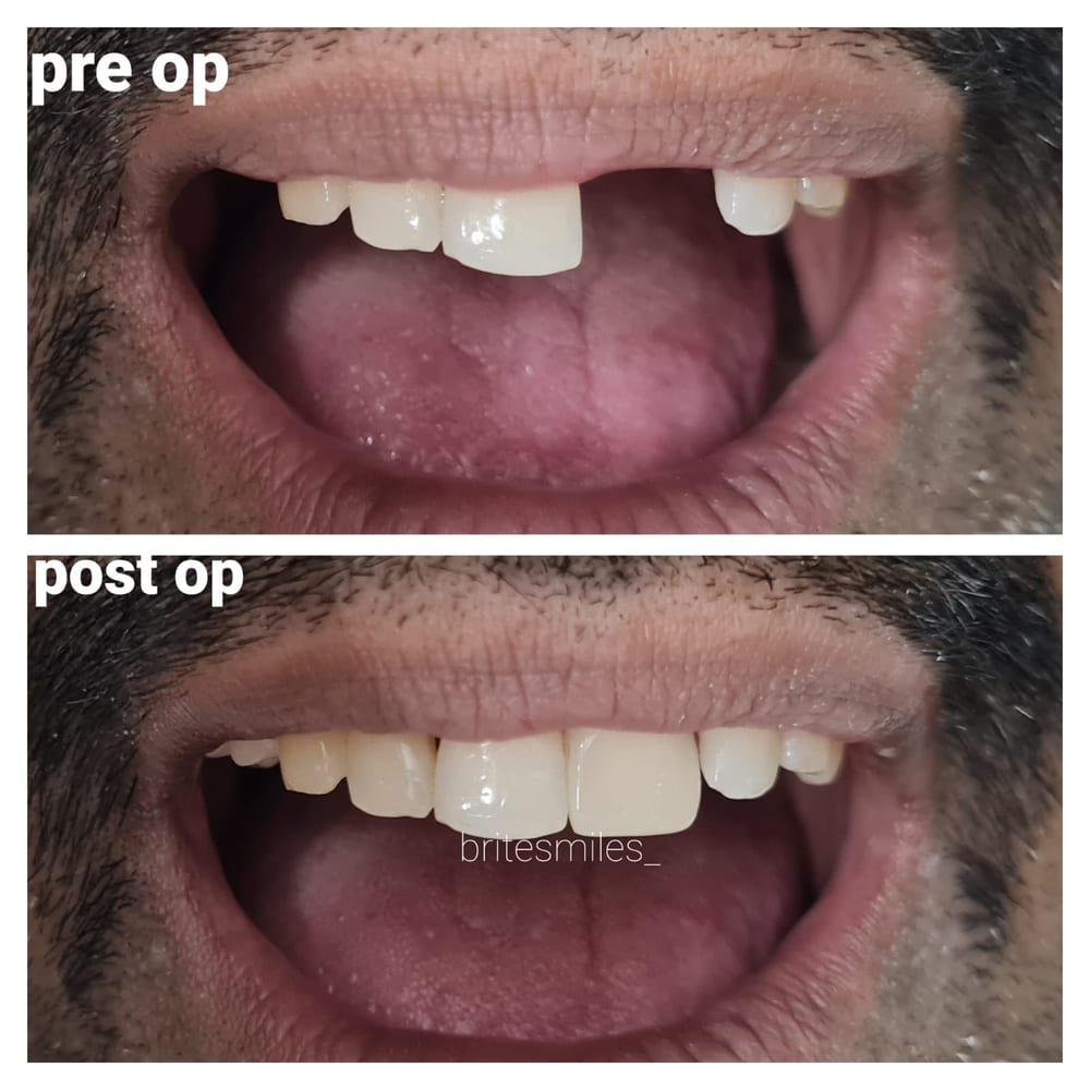 Back Tooth Replacement - After