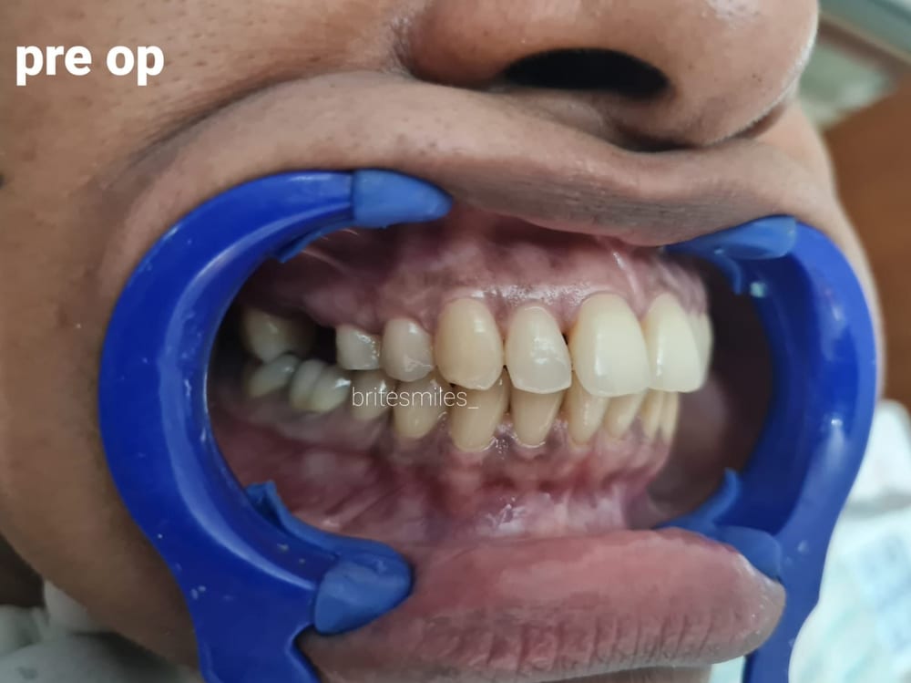 Back Tooth Replacement - Before