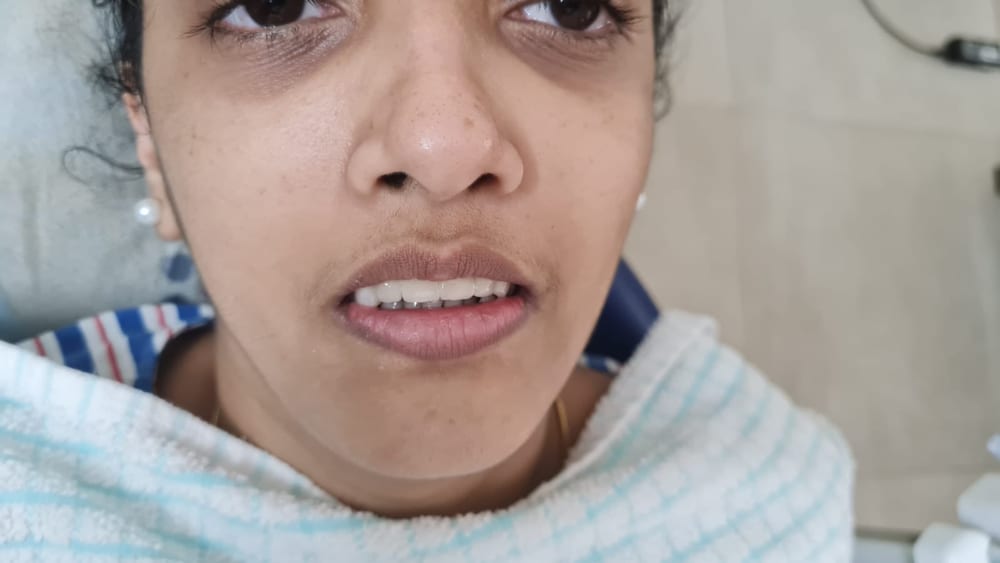 Fixed Teeth Replacement - After