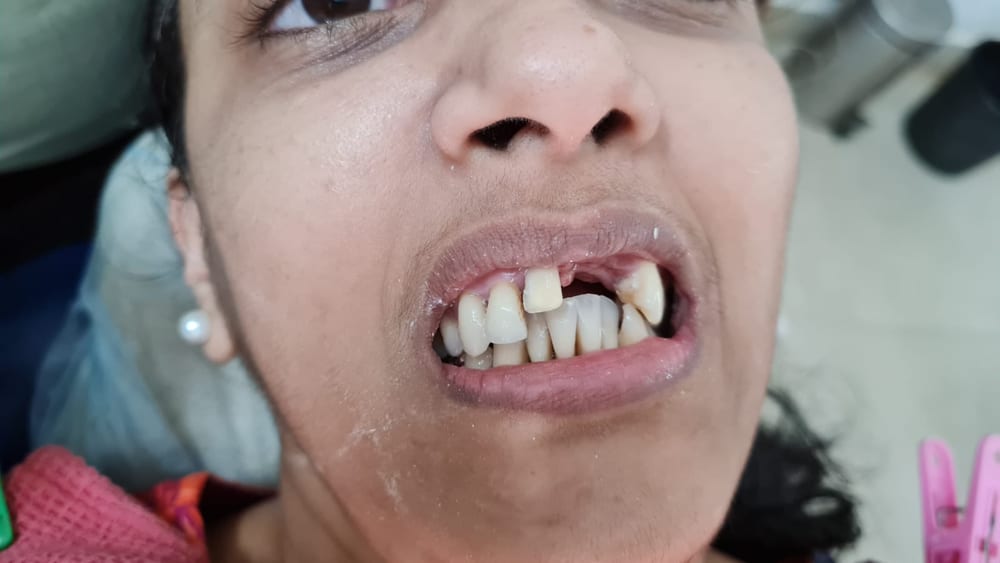 Fixed Teeth Replacement - Before
