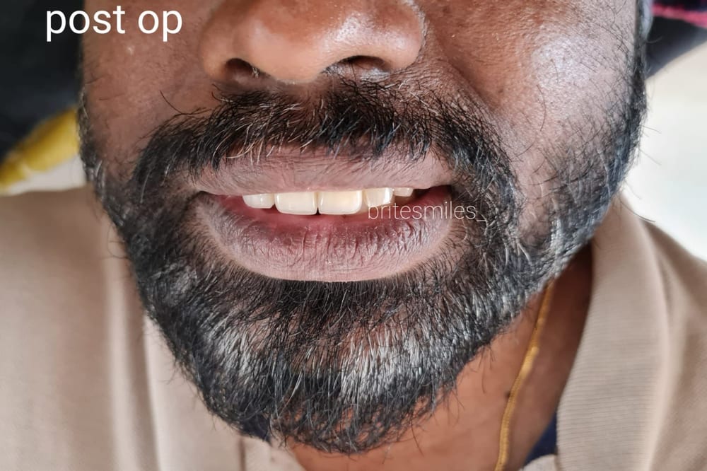 Removable Denture - After