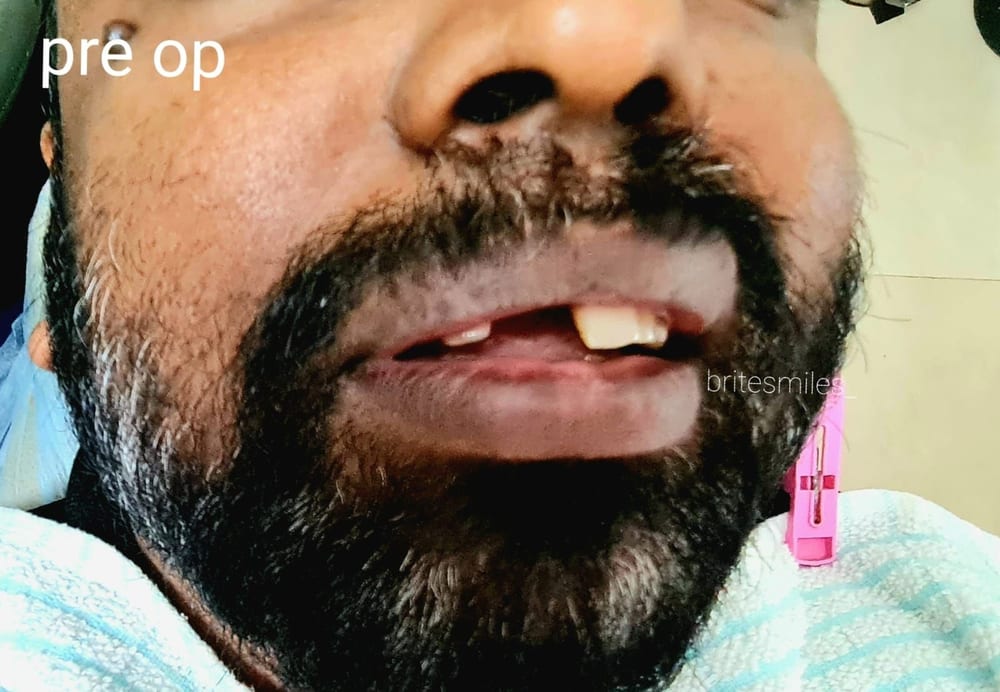 Removable Denture - Before