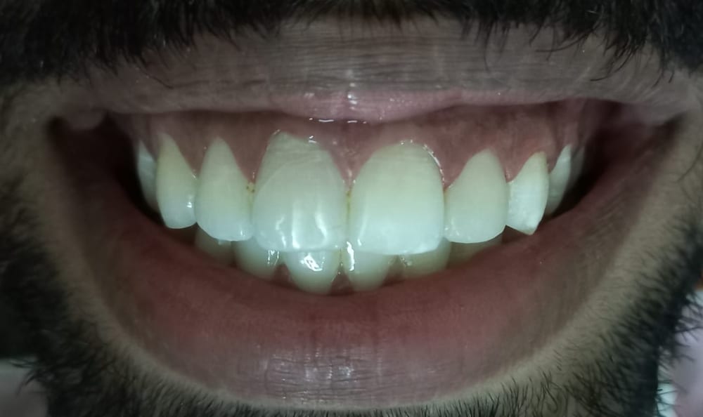 Composite Buildup - After