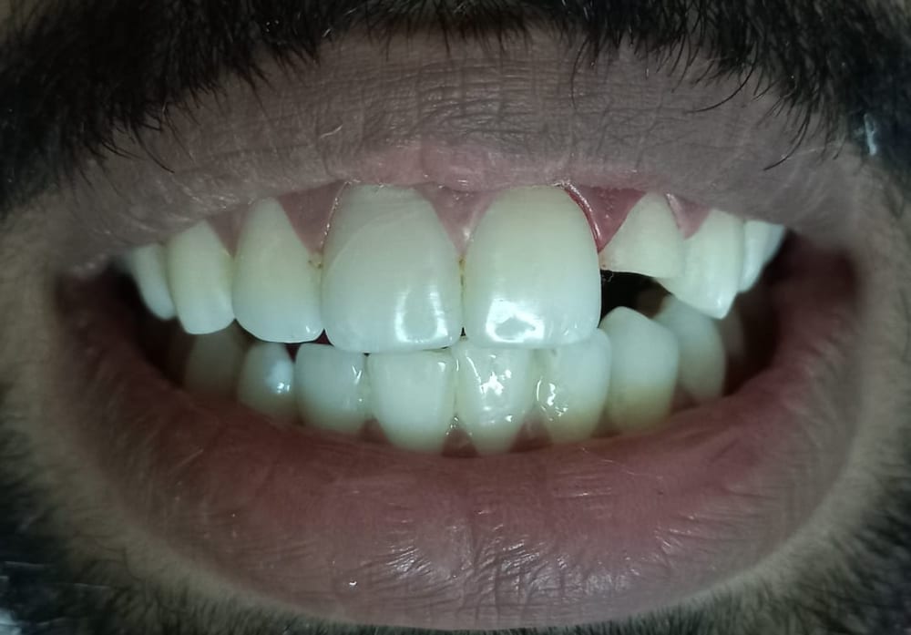 Composite Buildup - Before