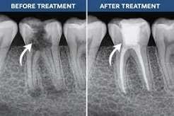 Root Canal Therapy Case