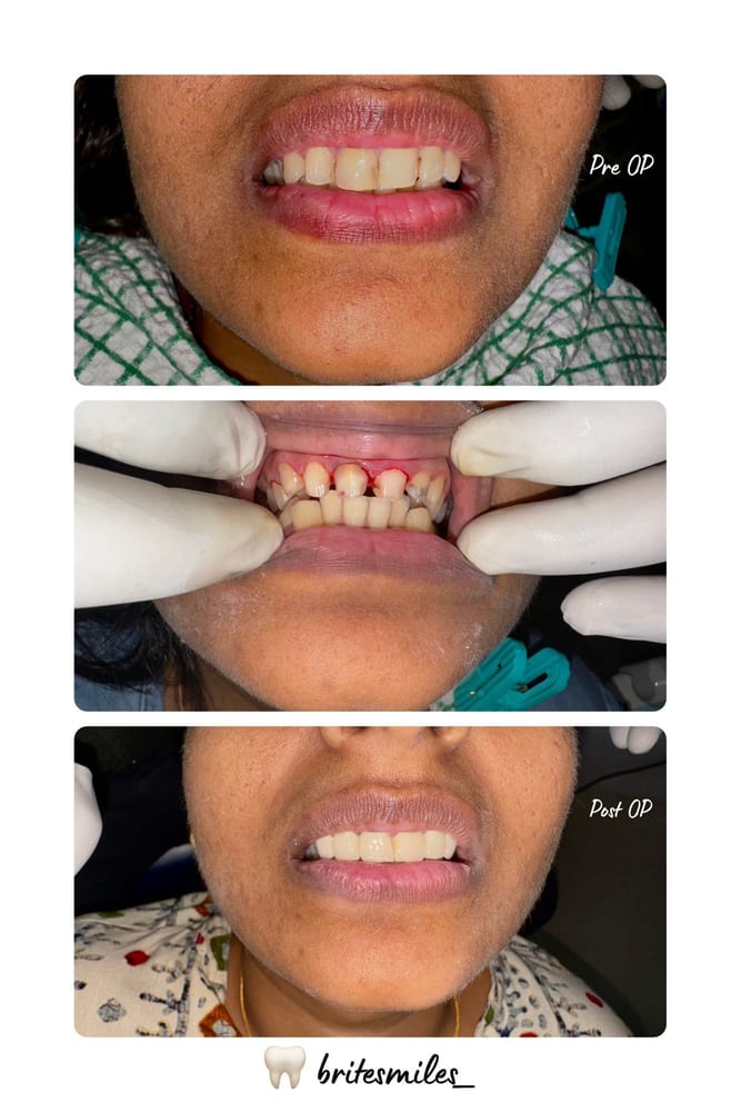 Smile Designing with Crowns