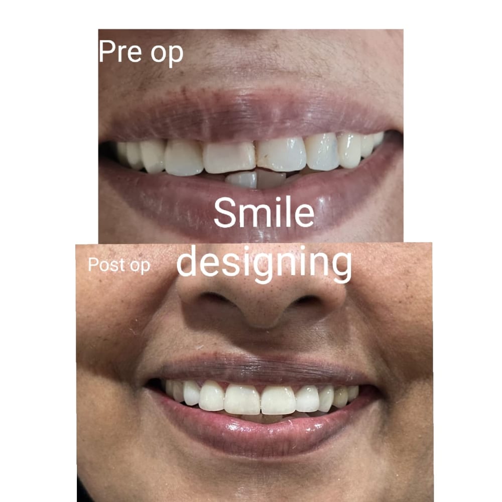 Smile Designing with Veneers