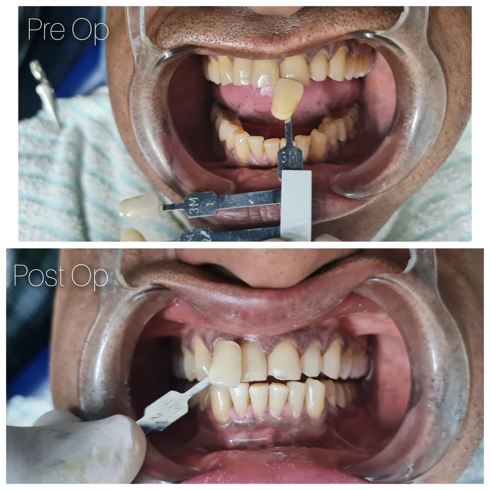 Teeth Whitening Case